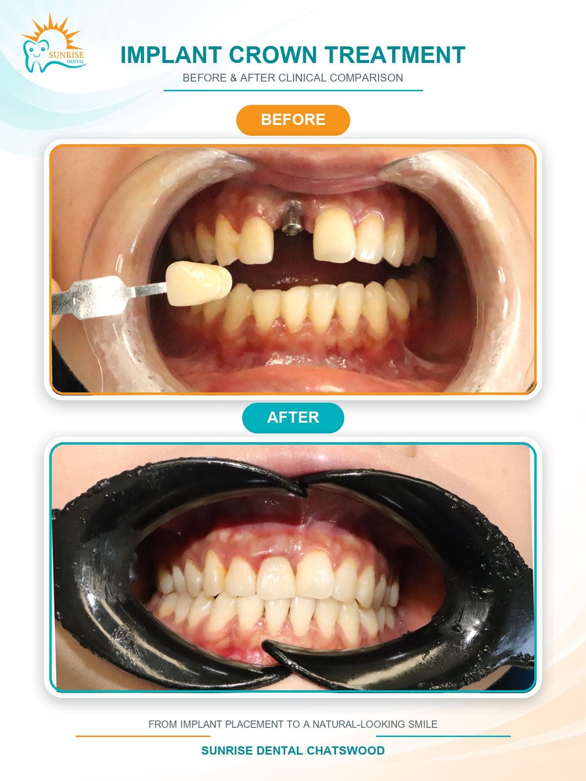 Implant crown: before and after