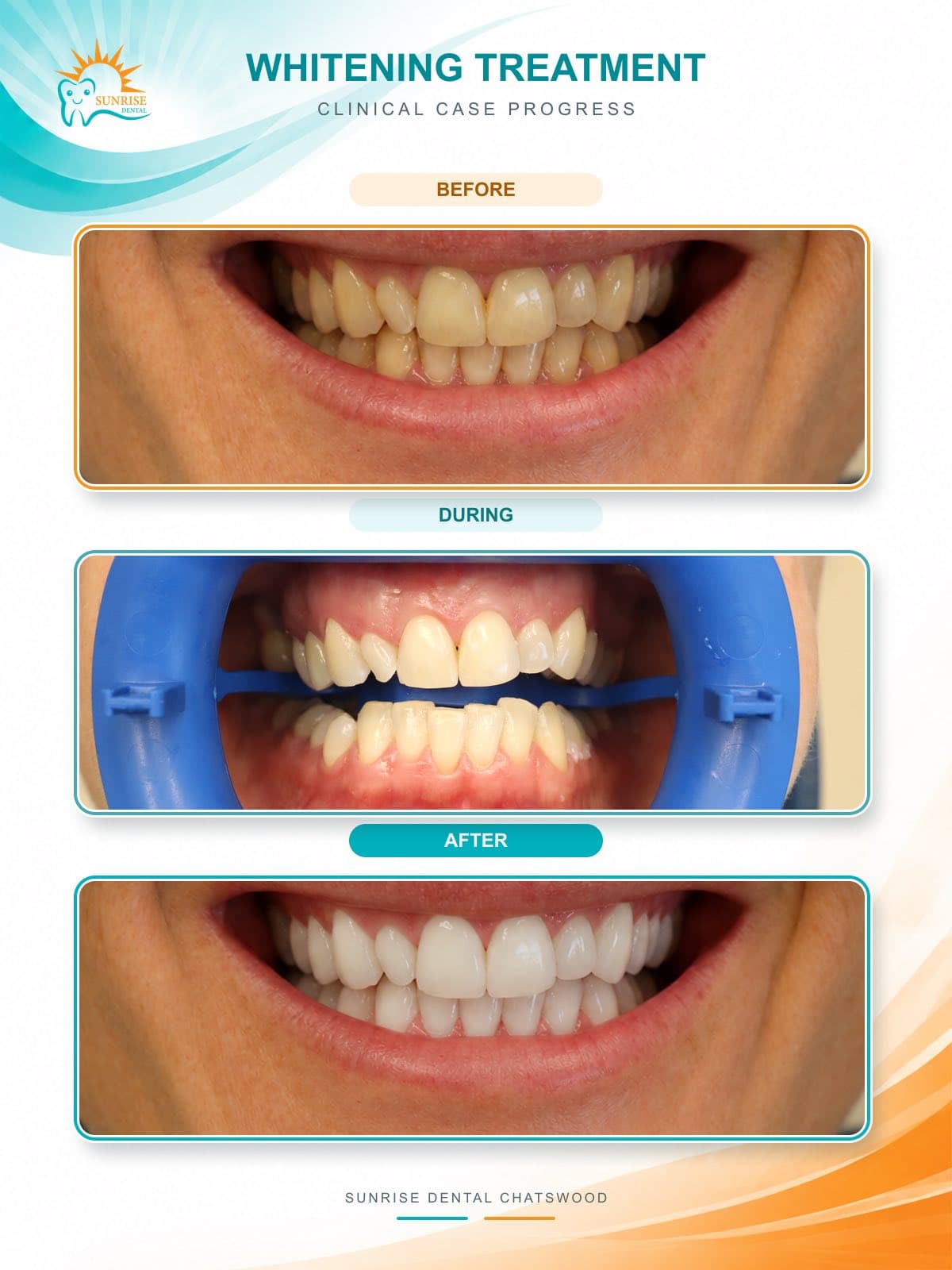 Whitening: before and after